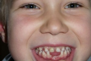 Deutlich frühere Vorsorgeuntersuchungen gefordert - Immer mehr Kleinkinder leiden unter frühkindlichen Zahnschäden
