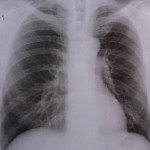 Robert-Koch-Institut warnt vor vermehrten multiresistenten Stämmen bei Tuberkulose Robert-Koch-Institut warnt vor vermehrten multiresistenten Stämmen bei Tuberkulose