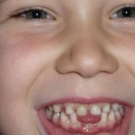 Deutlich frühere Vorsorgeuntersuchungen gefordert – Immer mehr Kleinkinder leiden unter frühkindlichen Zahnschäden