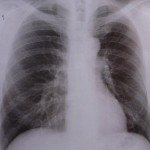 Robert-Koch-Institut warnt vor vermehrten multiresistenten Stämmen bei Tuberkulose